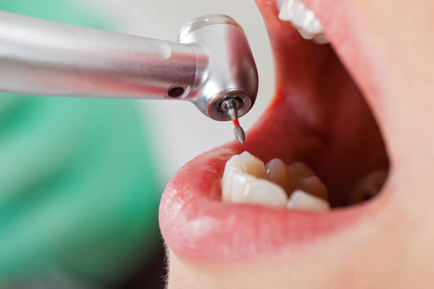 Best Lost Filling or Crown Replacement in Hudson, OH